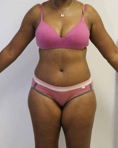 tummy tuck patient