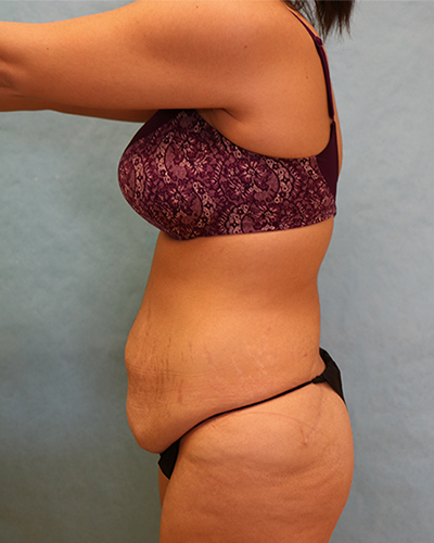 tummy tuck patient