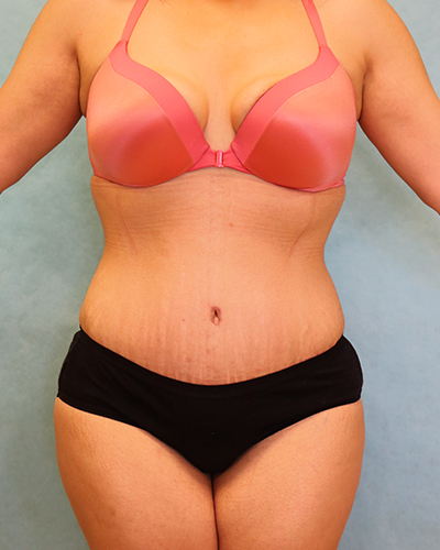 tummy tuck patient