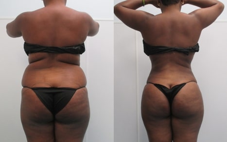 Awake Liposuction Before & After Silhouette in Sarasota