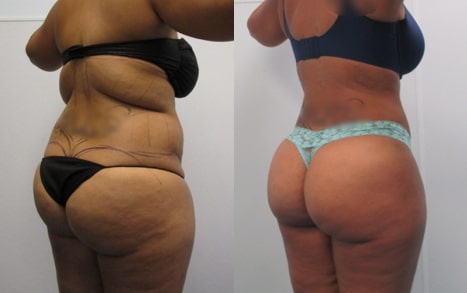 Awake Liposuction to the Back Before & After